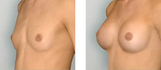 Breast Augmentation