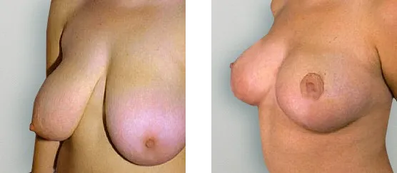 Breast Reduction