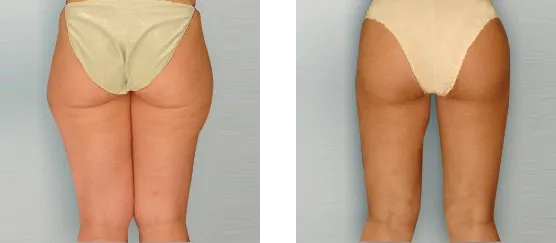 Liposuction