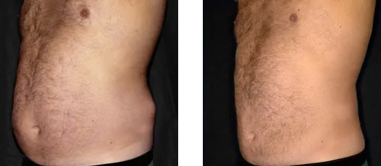 Liposuction 2