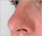 nose-surgery_01