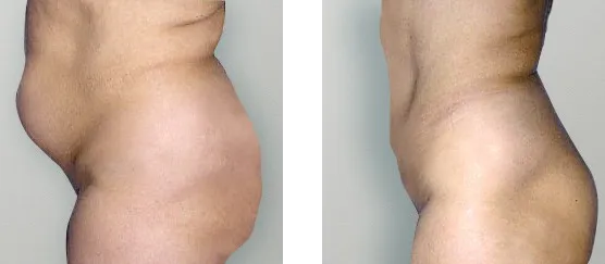 Tummy Tuck