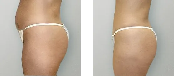Tummy Tuck 2